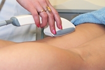 Epilation définitive